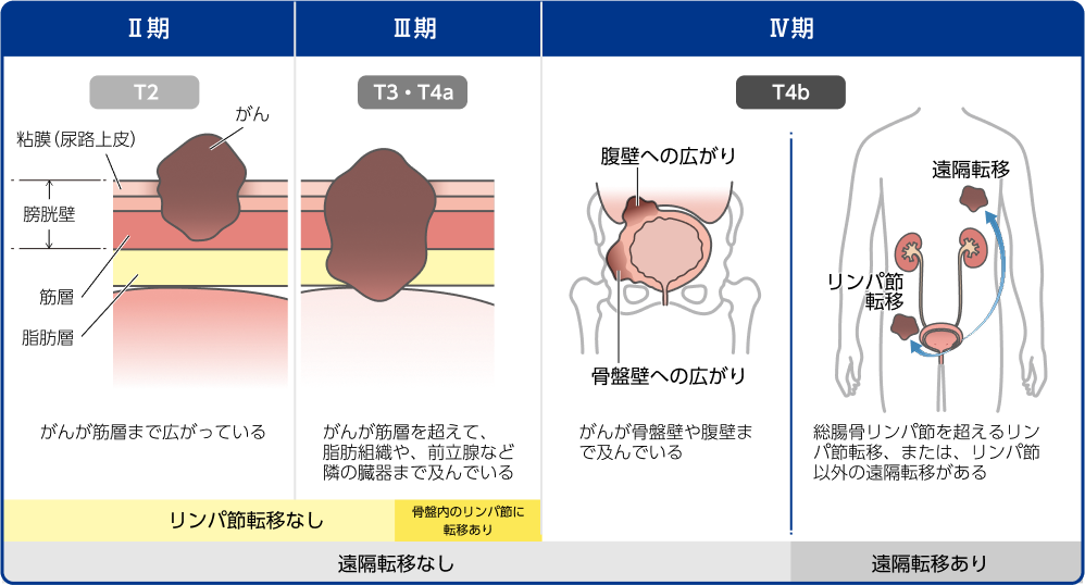 筋層浸潤性膀胱癌を病期（II期、III期、IV期）にわけて、膀胱壁のどこまで浸潤しているか、リンパ節転移・遠隔転移について示すイラスト