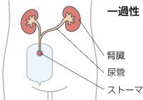 尿管皮膚ろう造設術の種類（一過性、両側性）とストーマ装具のイラスト