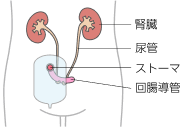 回腸導管造設術とストーマ装具のイラスト