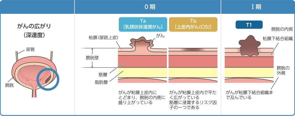 筋層非浸潤性膀胱癌を病期（0期、I期）にわけて、膀胱壁のどこまで浸潤しているか、深達度について示すイラスト