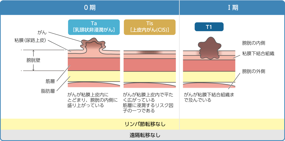筋層非浸潤性膀胱癌を病期（0期、I期）にわけて、膀胱壁のどこまで浸潤しているかを示すイラスト