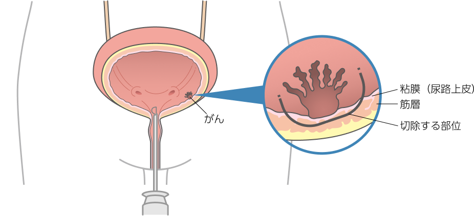 経尿道的膀胱腫瘍切除術（TURBT）のイラスト。尿道から内視鏡に挿入し、電気メスで膀胱癌を切除することを示す