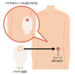 尿の出口（尿路ストーマ）を示す膀胱癌患者さんのイラスト