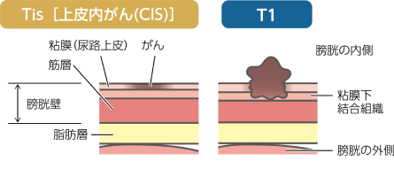 筋層非浸潤性膀胱癌の高リスク・超高リスクに分類されるT1とTis［上皮内がん（Cis）］のイラスト
