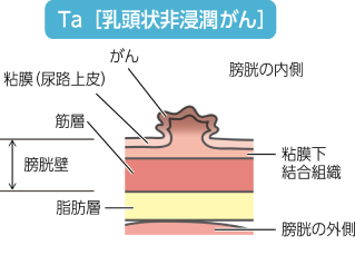 筋層非浸潤性膀胱癌の低リスクに分類される乳頭状非浸潤性がん（Ta）のイラスト