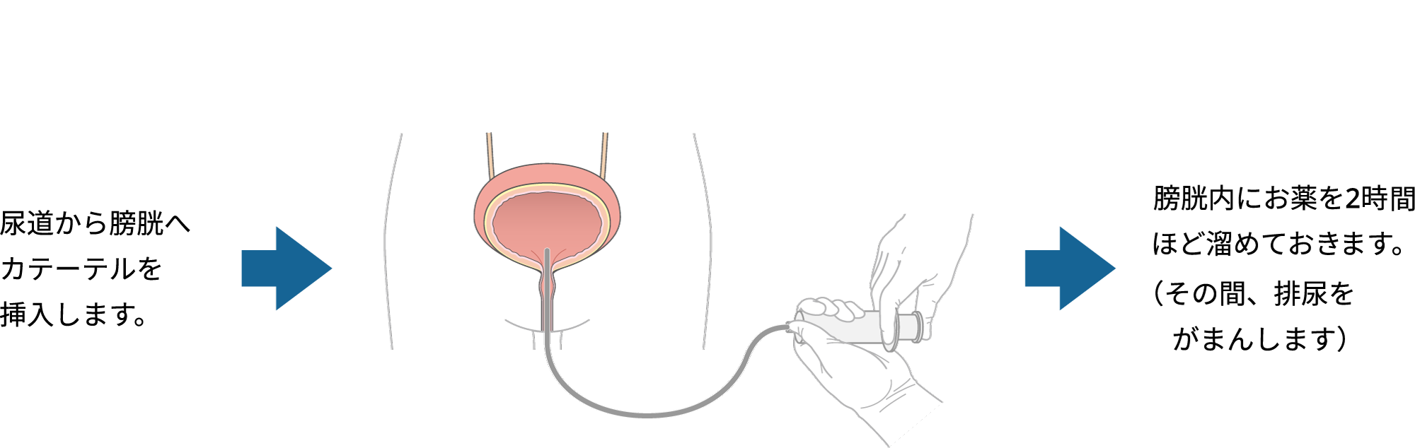 膀胱内注入療法（抗がん薬またはBCG）のイラスト