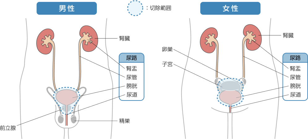 膀胱全摘除術について、男性と女性の切除範囲を示すイラスト