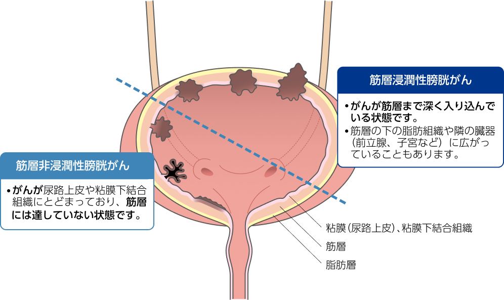 膀胱癌が尿路上皮や粘膜下結合組織にとどまっている「筋層非浸潤性膀胱癌」と、膀胱癌が筋層まで深く入り込んでいる「筋層浸潤性膀胱癌」のイラスト